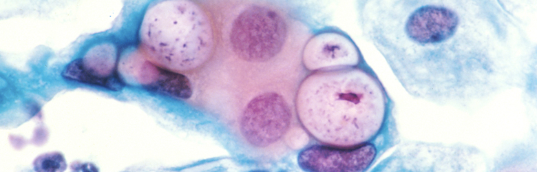 Chlamydia y su peligroso vínculo con la infertilidad